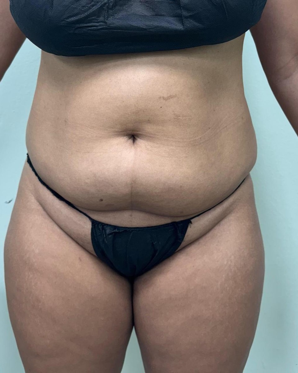 Abdominoplastia - Antes #14