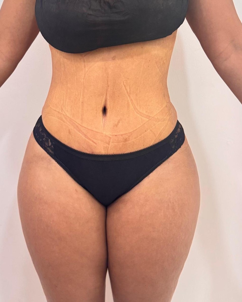 Abdominoplastia - Después