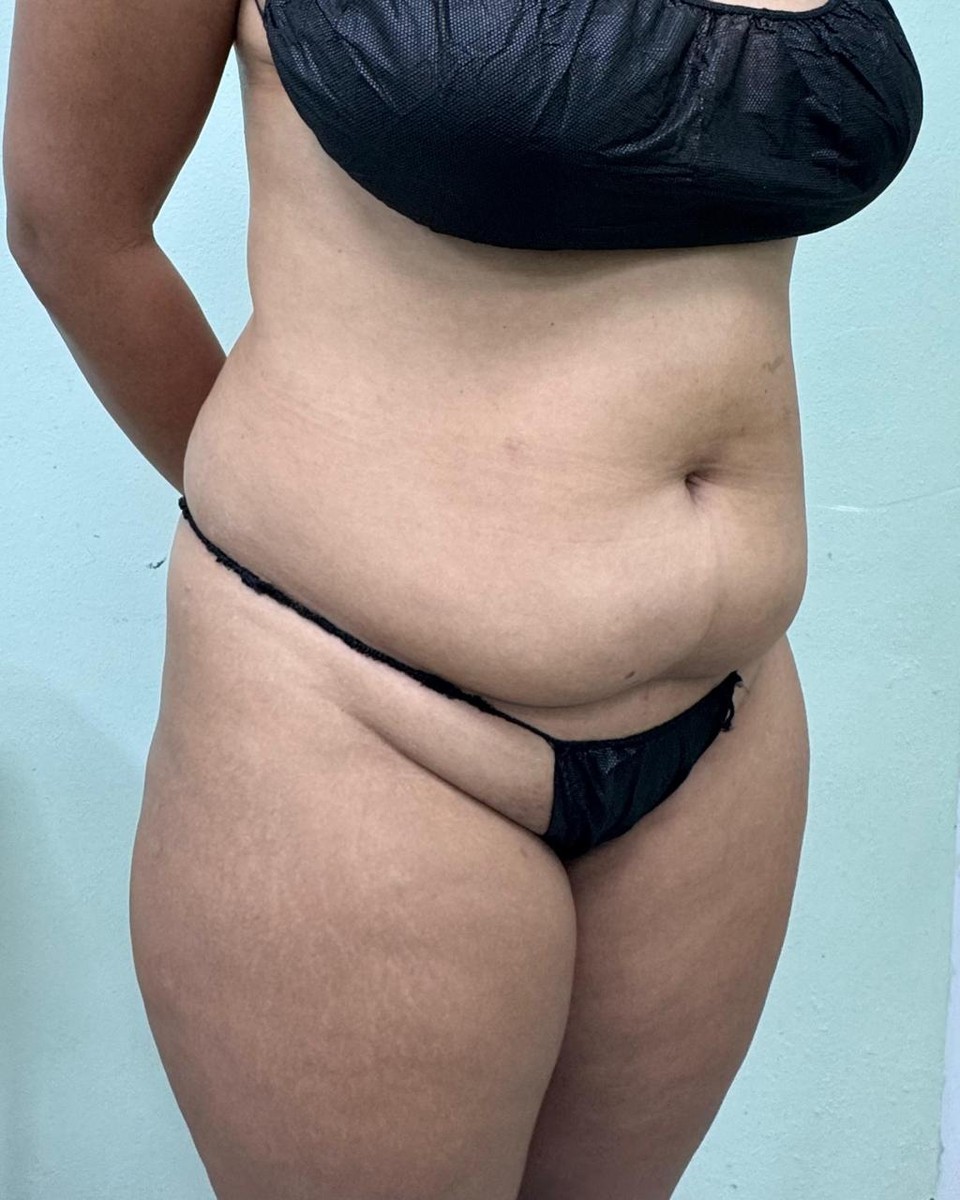 Abdominoplastia - Antes #15