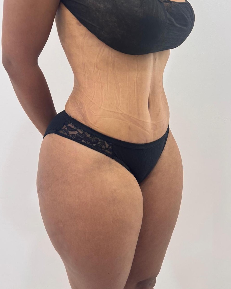 Abdominoplastia - Después #15
