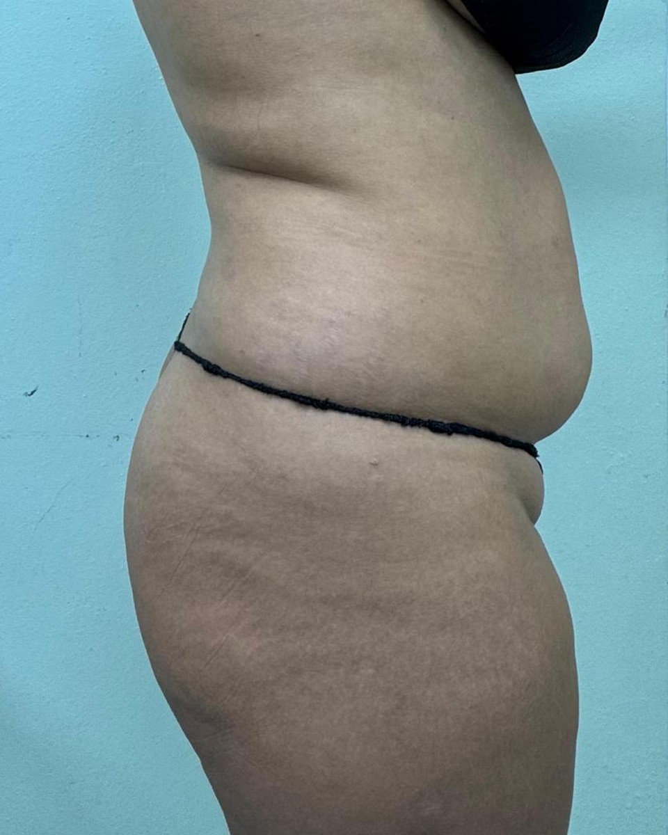 Abdominoplastia - Antes #16