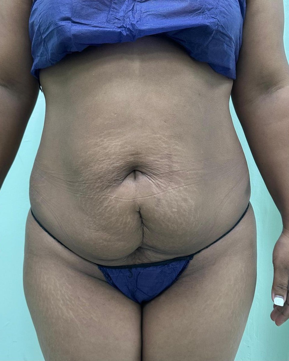 Abdominoplastia - Antes #17
