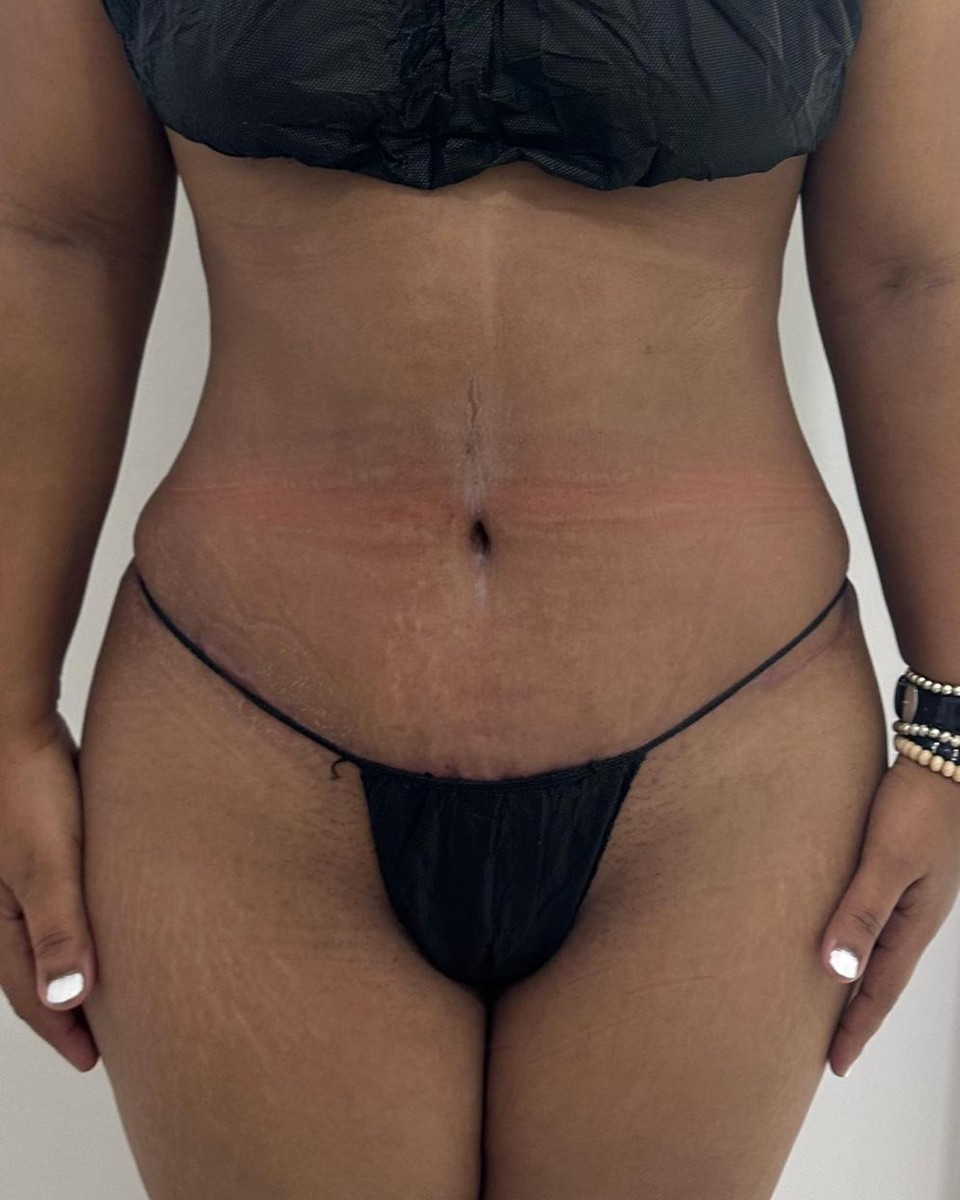 Abdominoplastia - Después #17