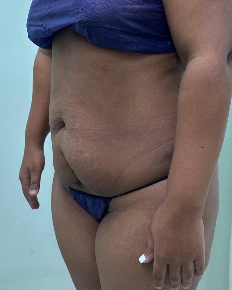 Abdominoplastia - Antes #18