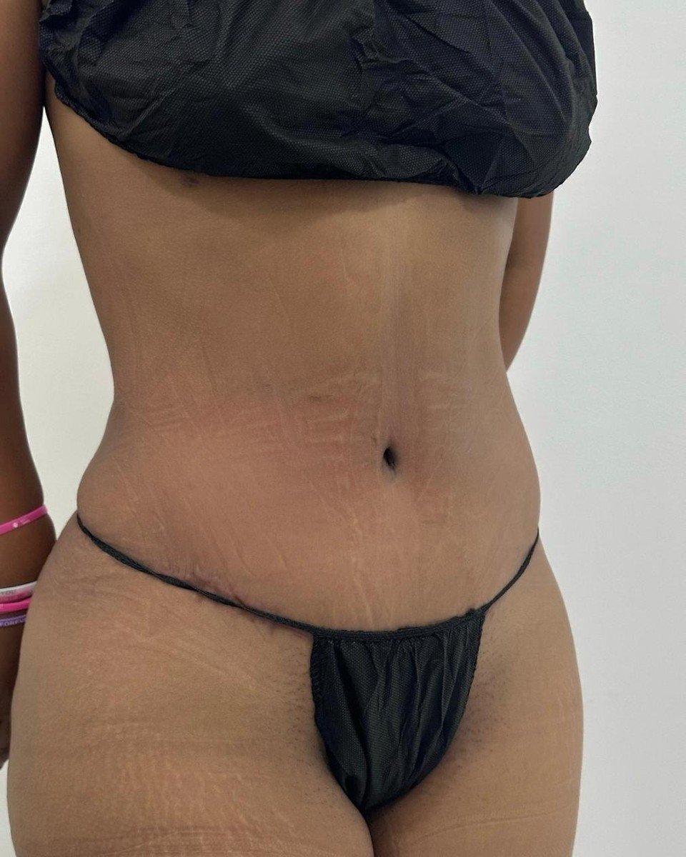Abdominoplastia - Después #18
