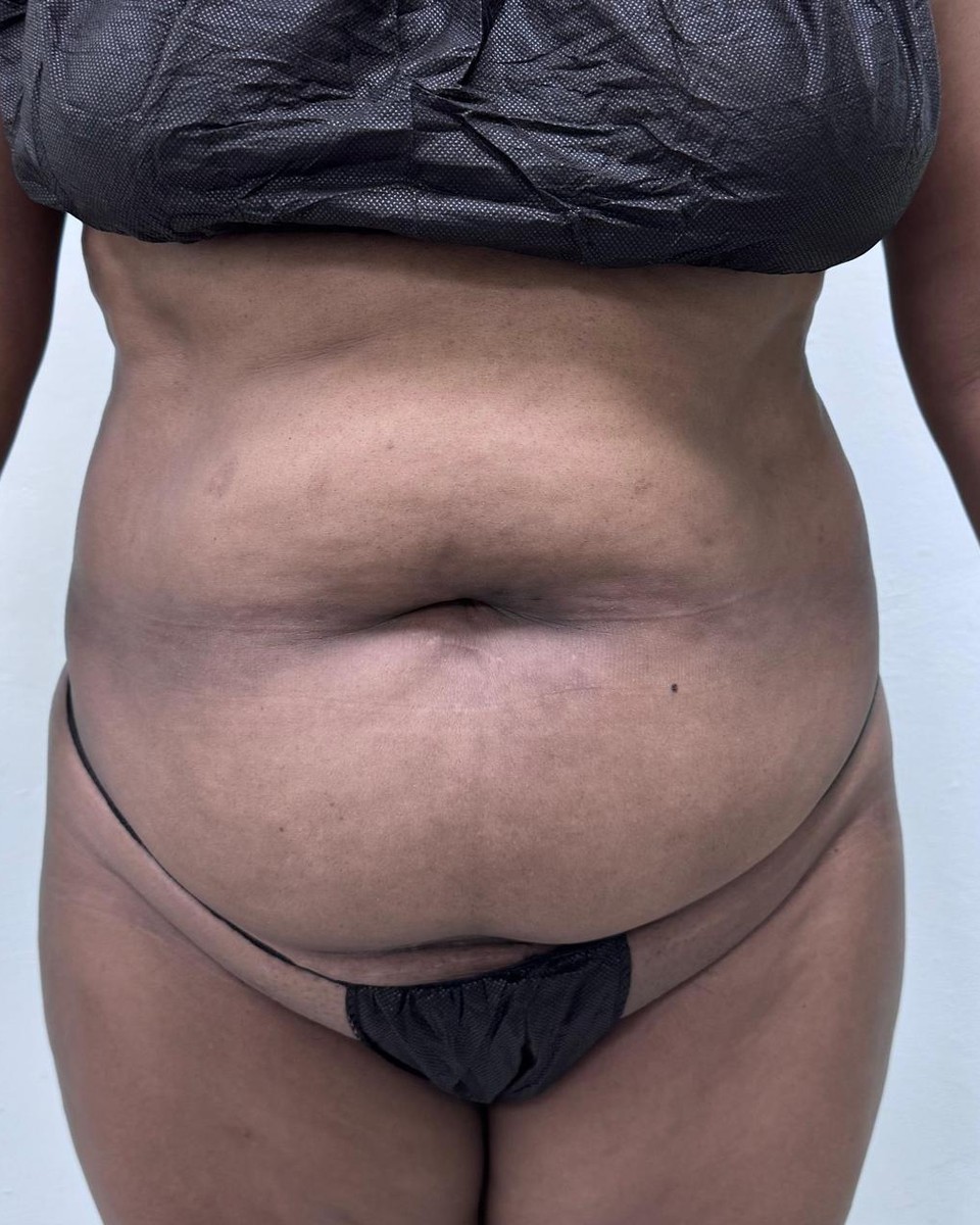Abdominoplastia - Antes #19