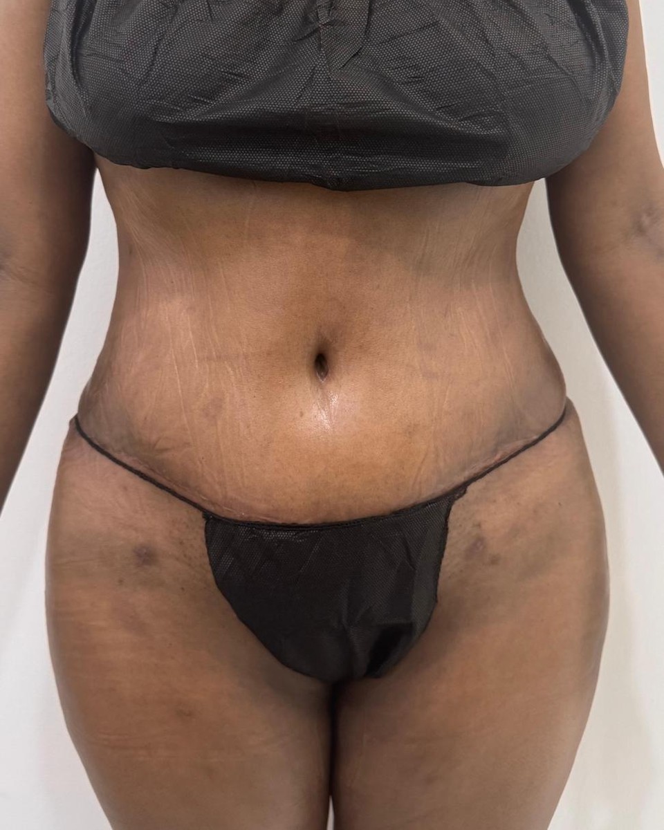 Abdominoplastia - Después #19