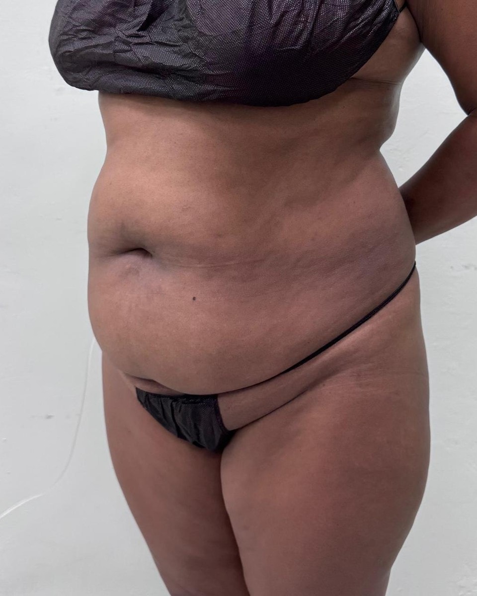 Abdominoplastia - Antes