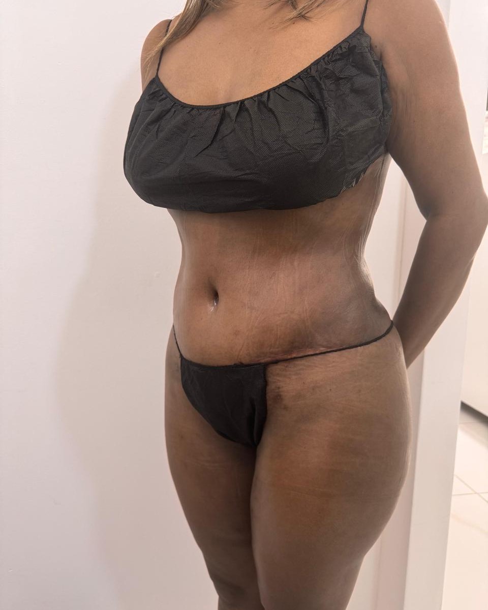 Abdominoplastia - Después #20
