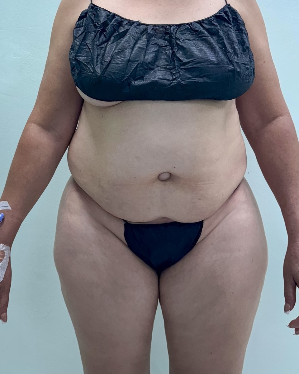 Abdominoplastia - Antes