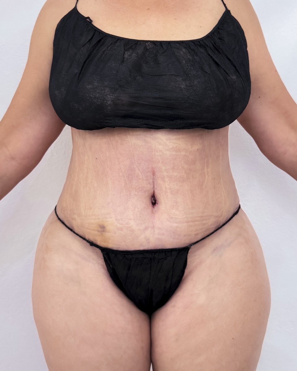 Abdominoplastia - Después