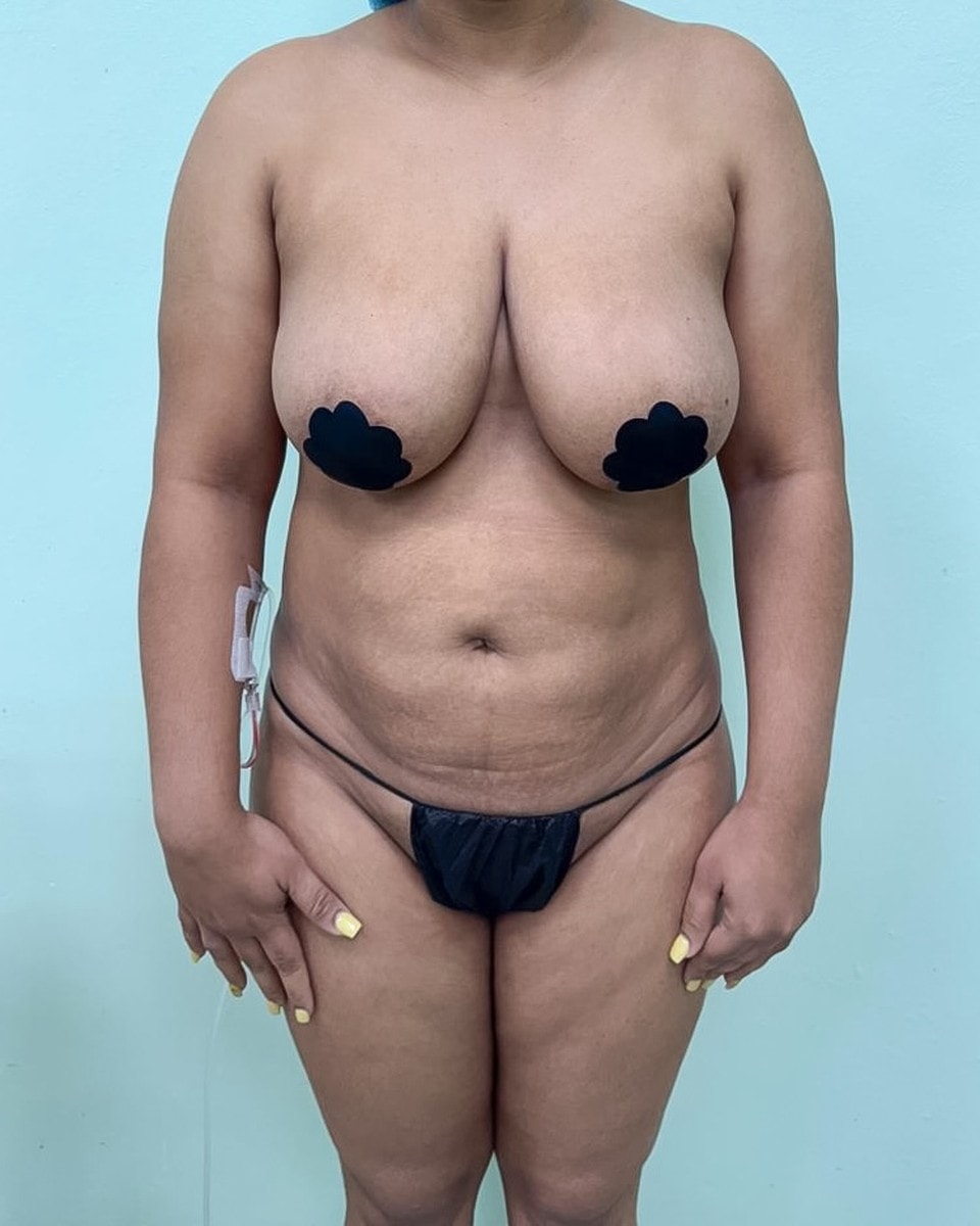 Abdominoplastia - Antes