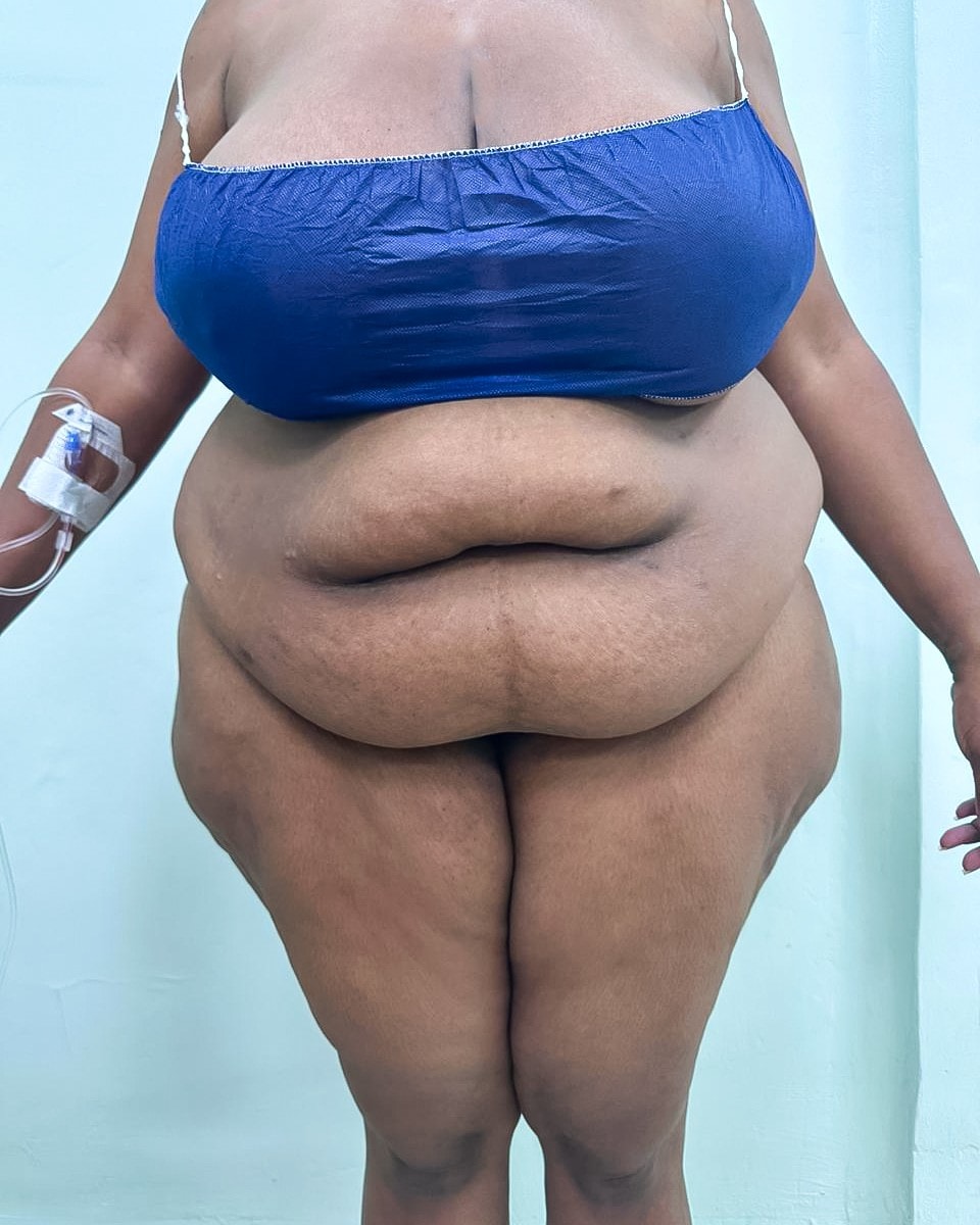 Abdominoplastia - Antes