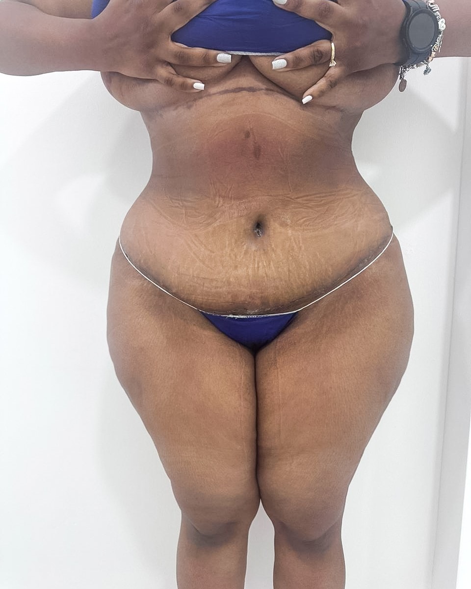 Abdominoplastia - Después