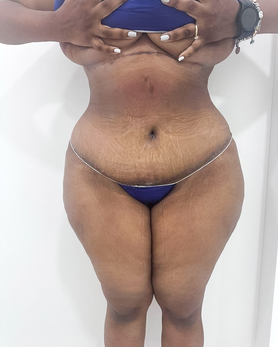 Abdominoplastia - Después #3