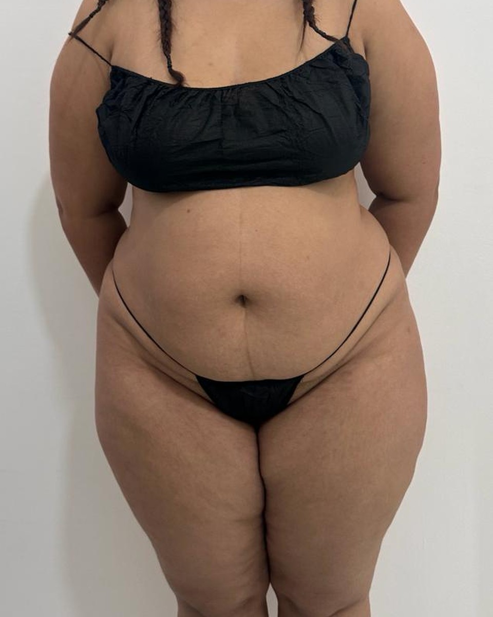 Abdominoplastia - Antes #4
