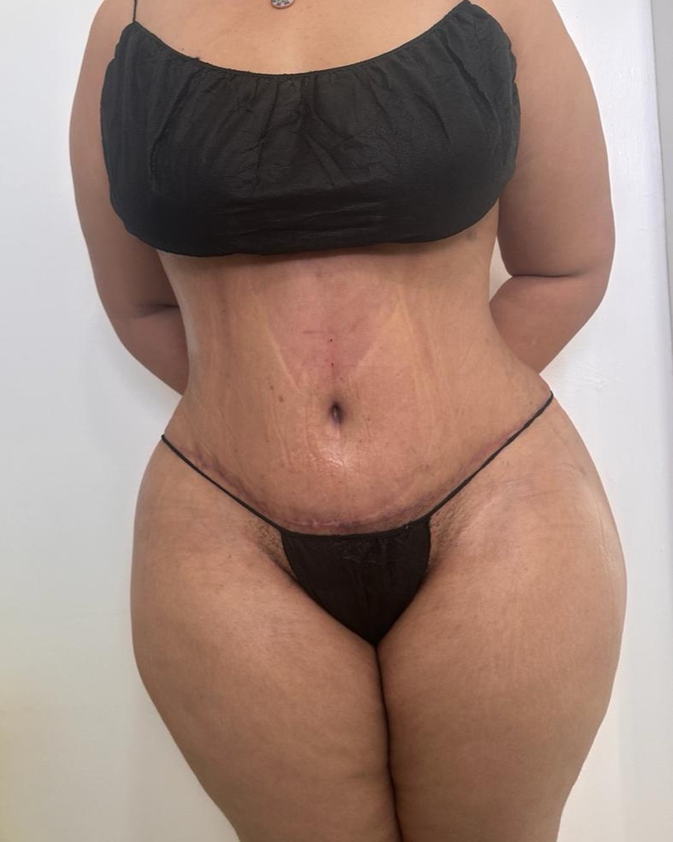 Abdominoplastia - Después #4