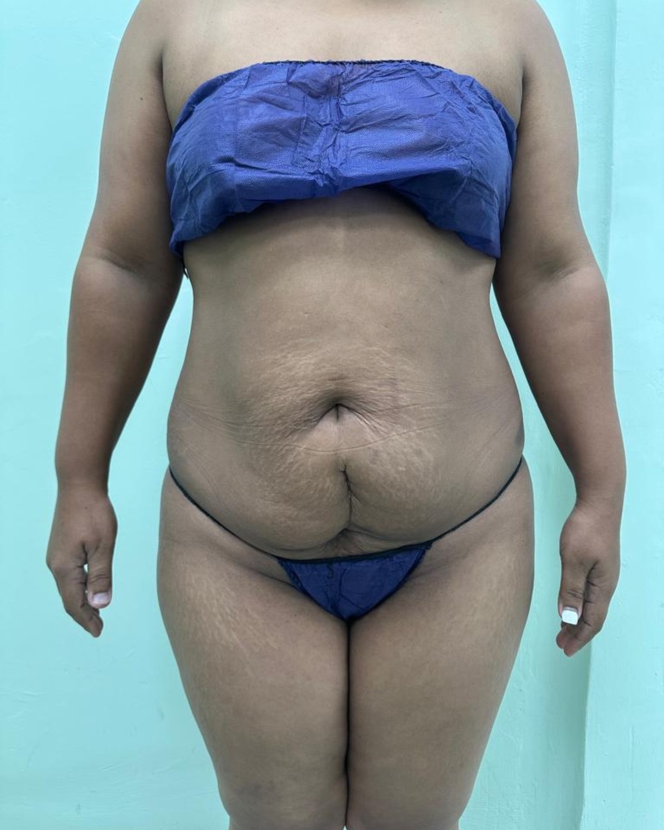 Abdominoplastia - Antes #5