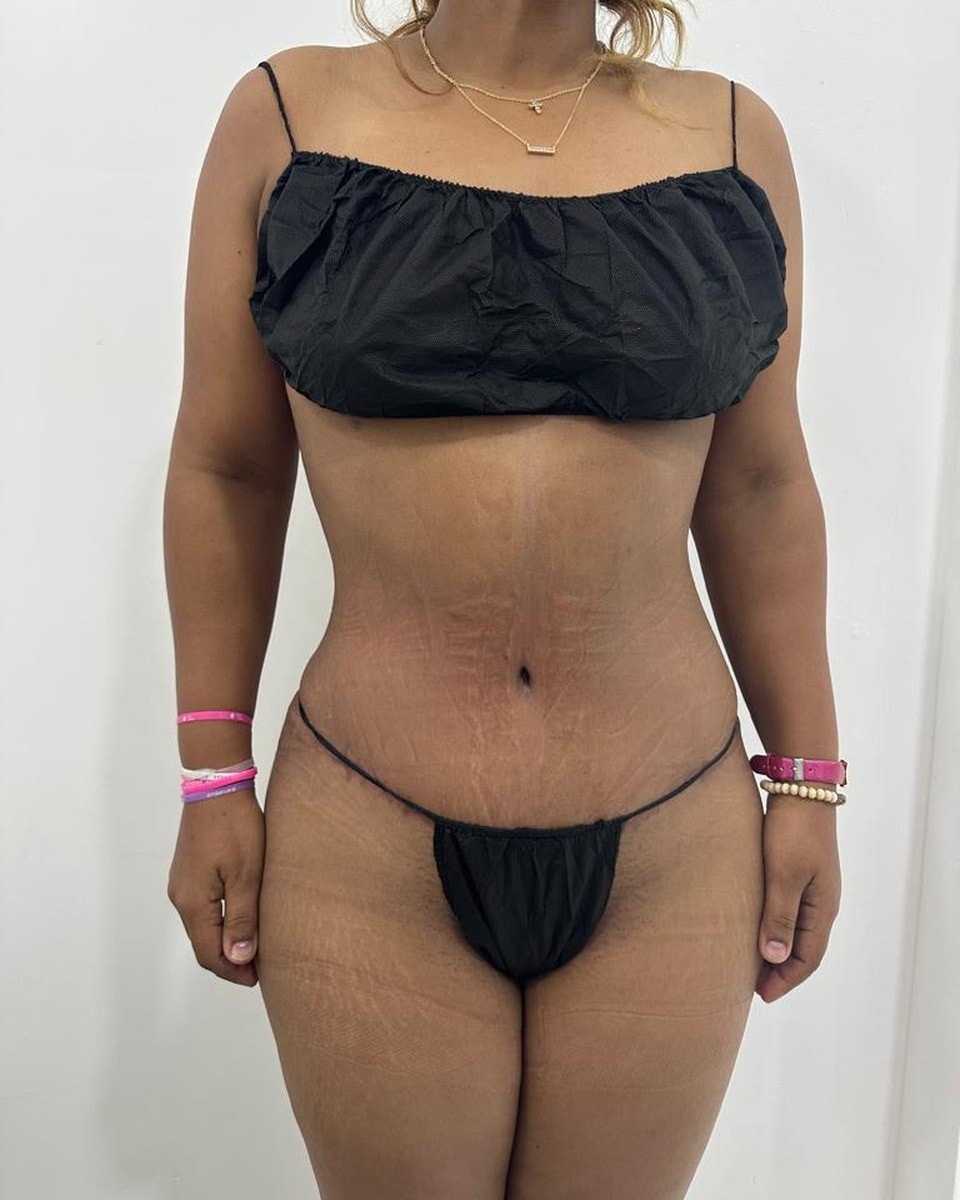 Abdominoplastia - Después