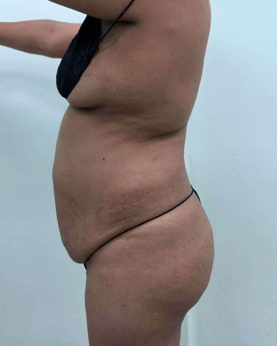 Abdominoplastia - Antes
