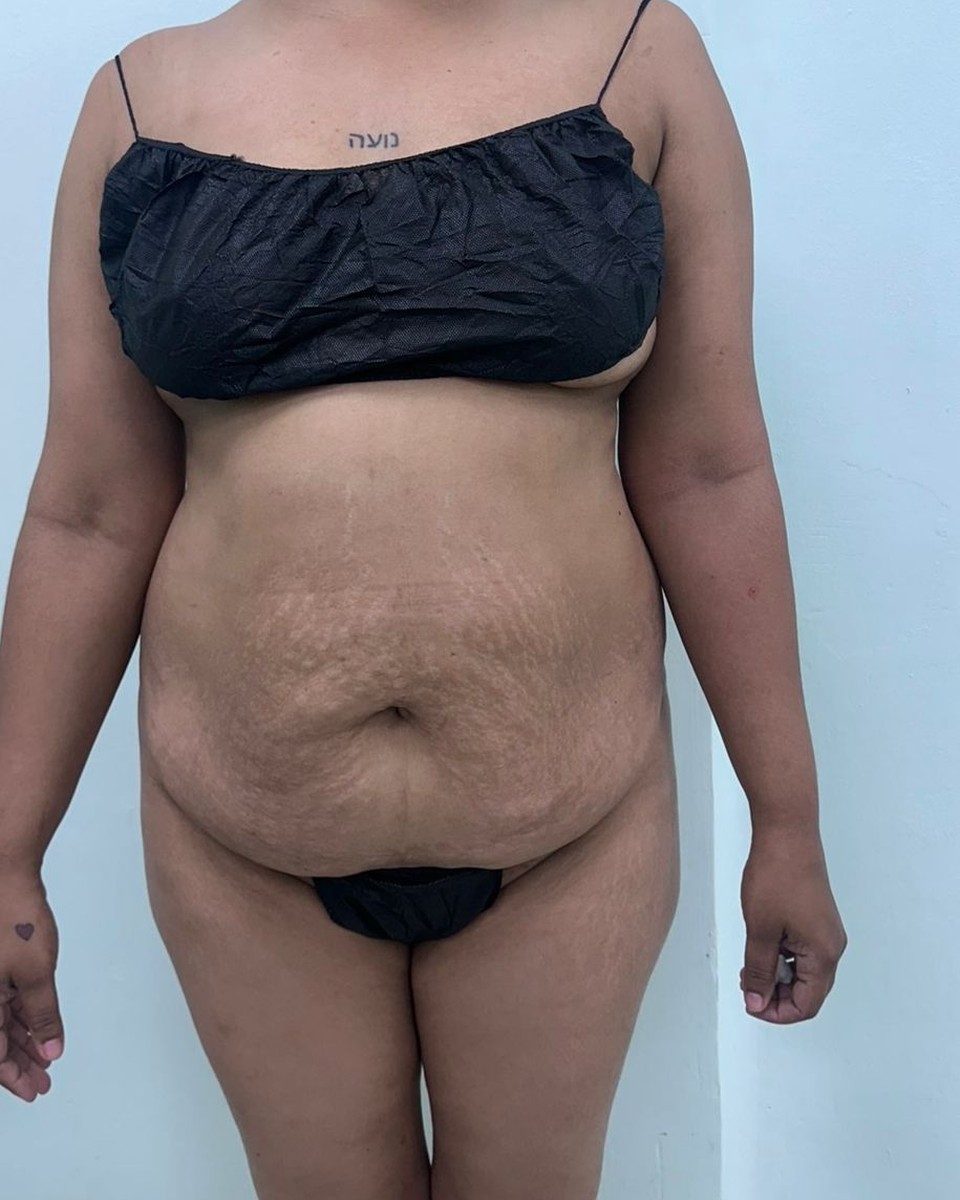 Abdominoplastia - Antes #7
