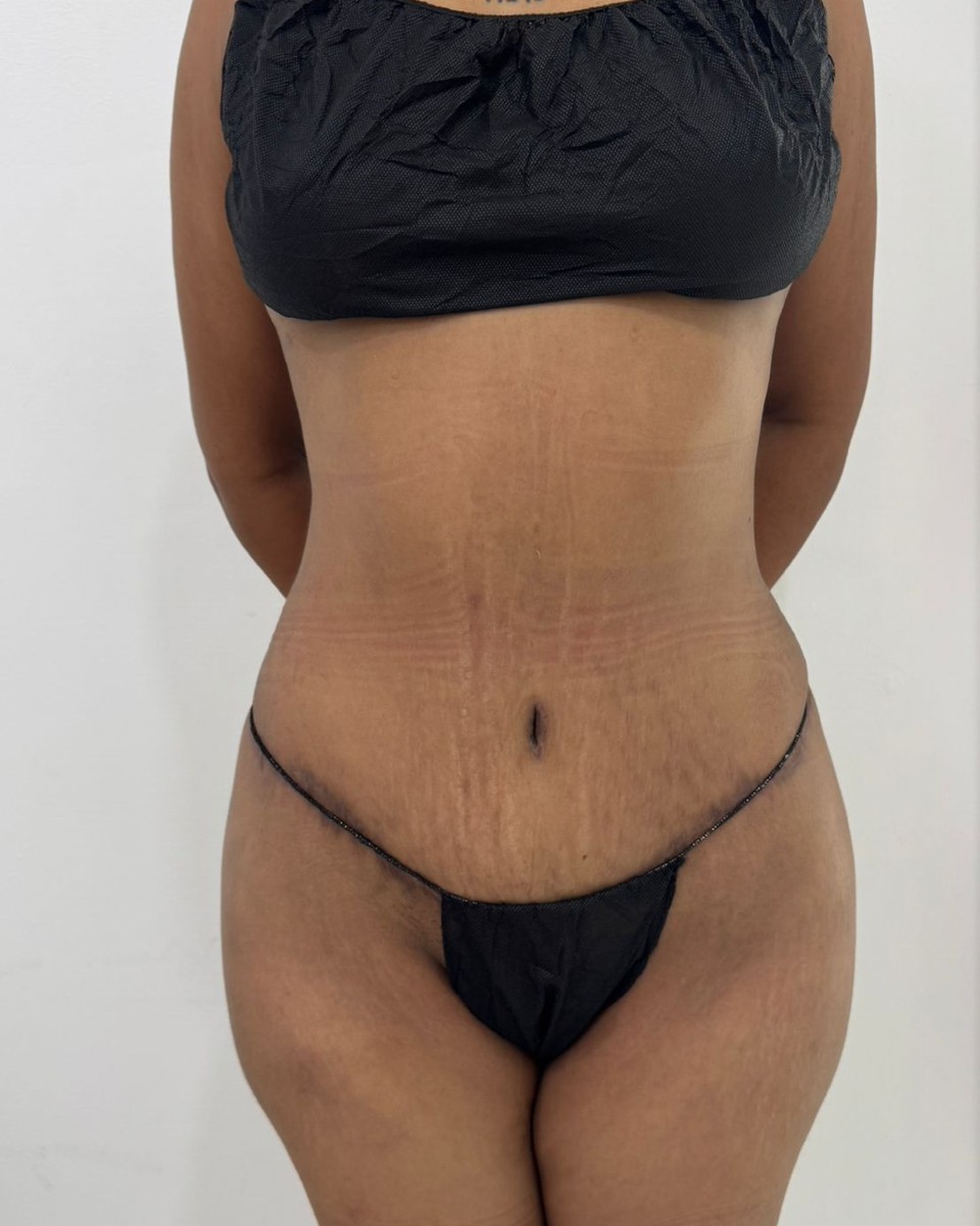 Abdominoplastia - Después #7