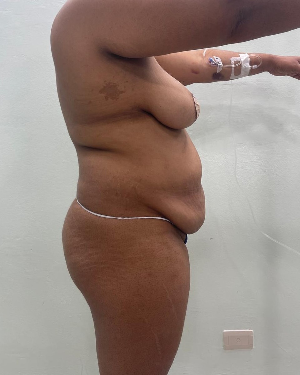 Abdominoplastia - Antes #8