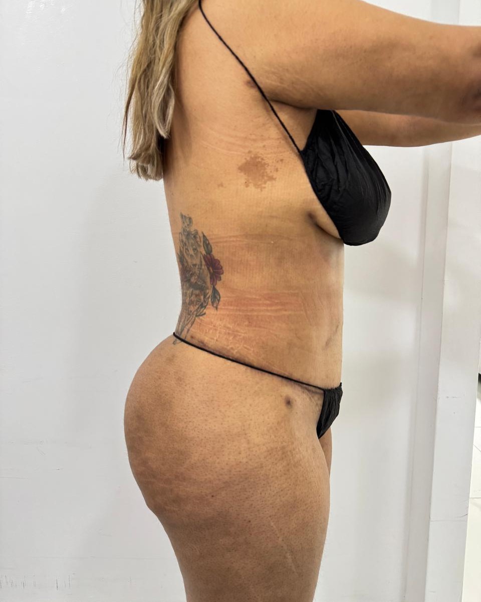 Abdominoplastia - Después #8