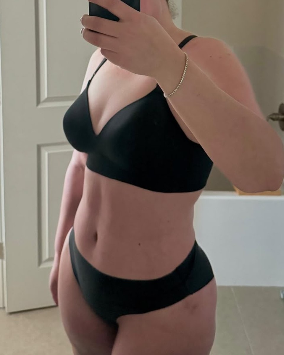 Abdominoplastia