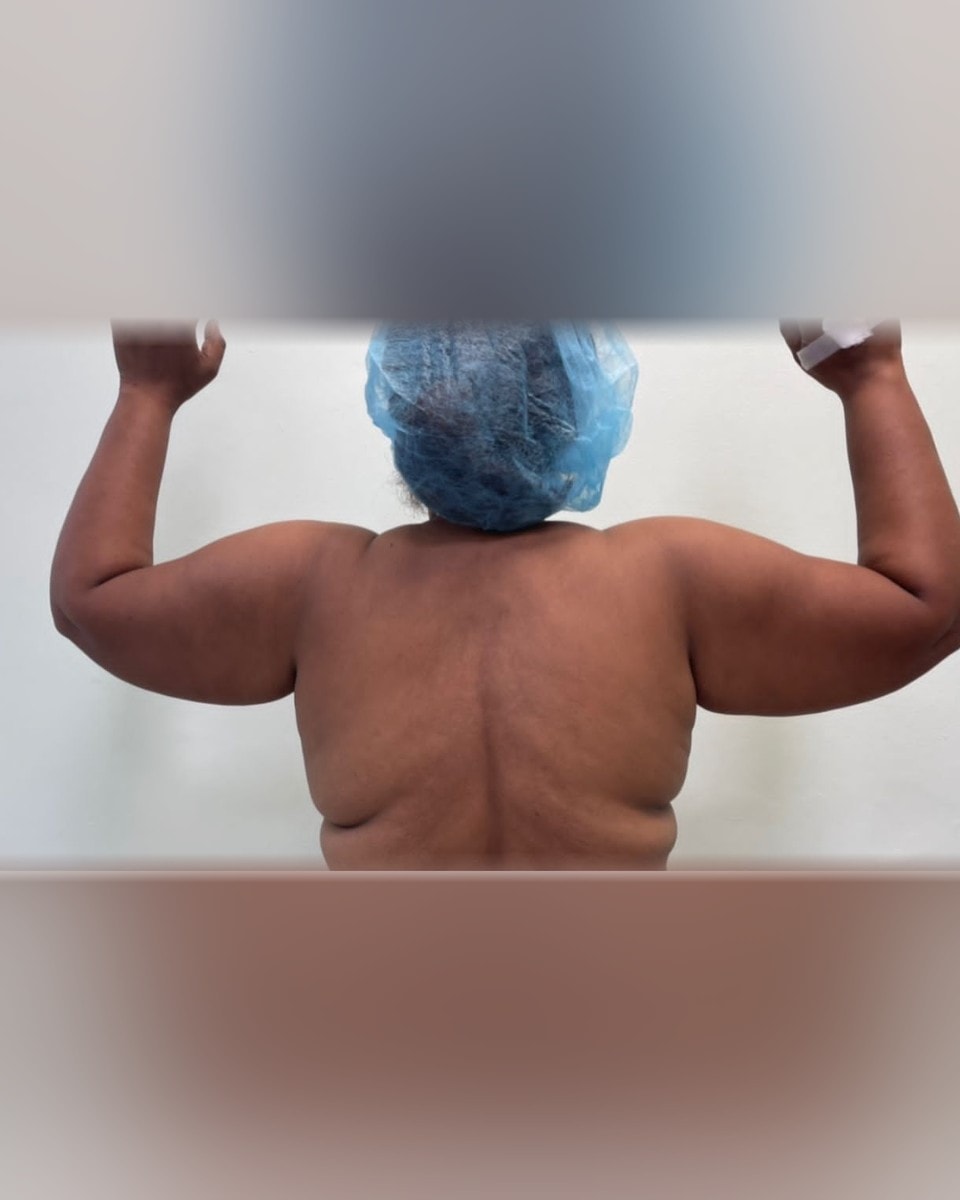 Lipoescultura - Antes