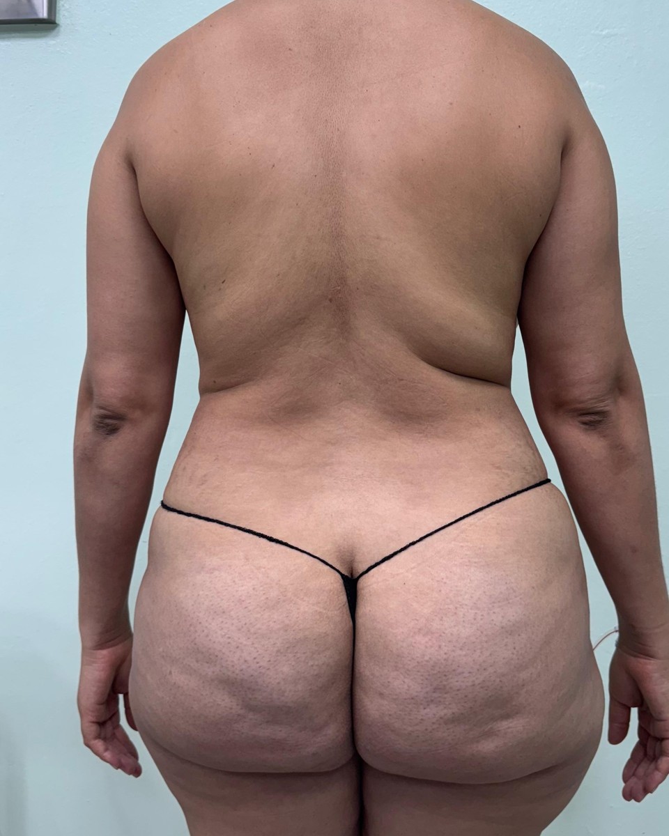 Lipoescultura - Antes #4