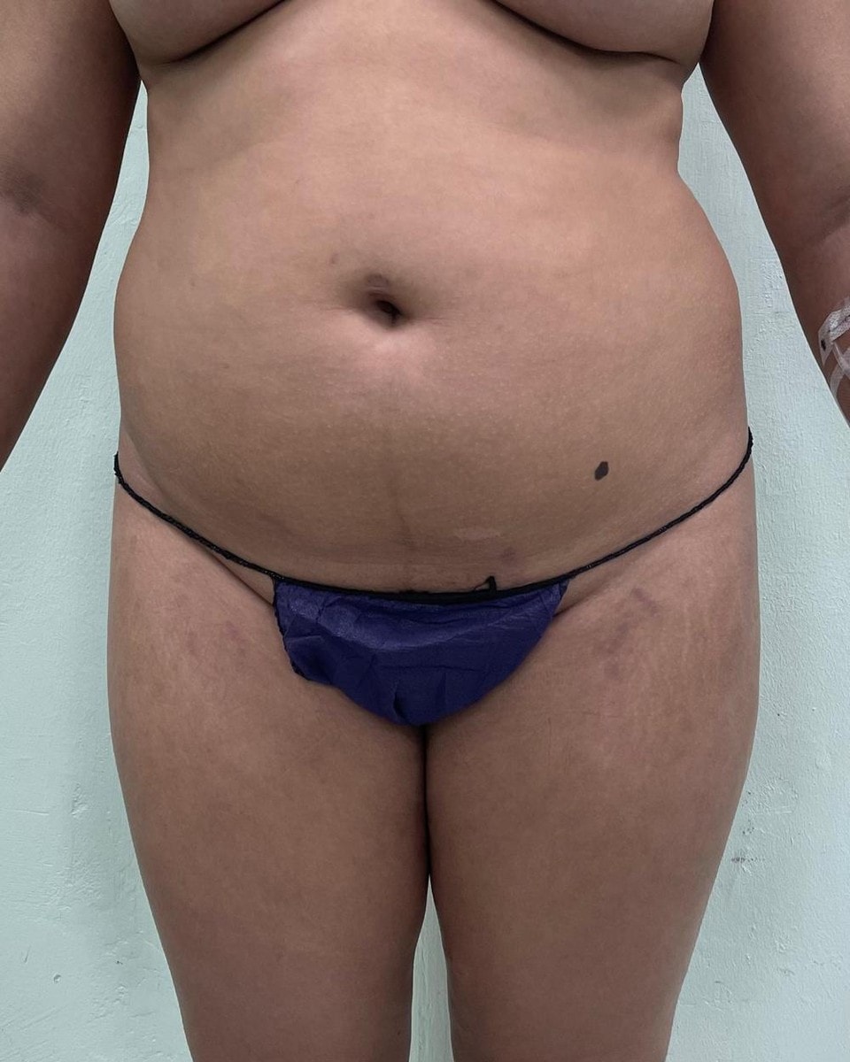 Lipoescultura - Antes