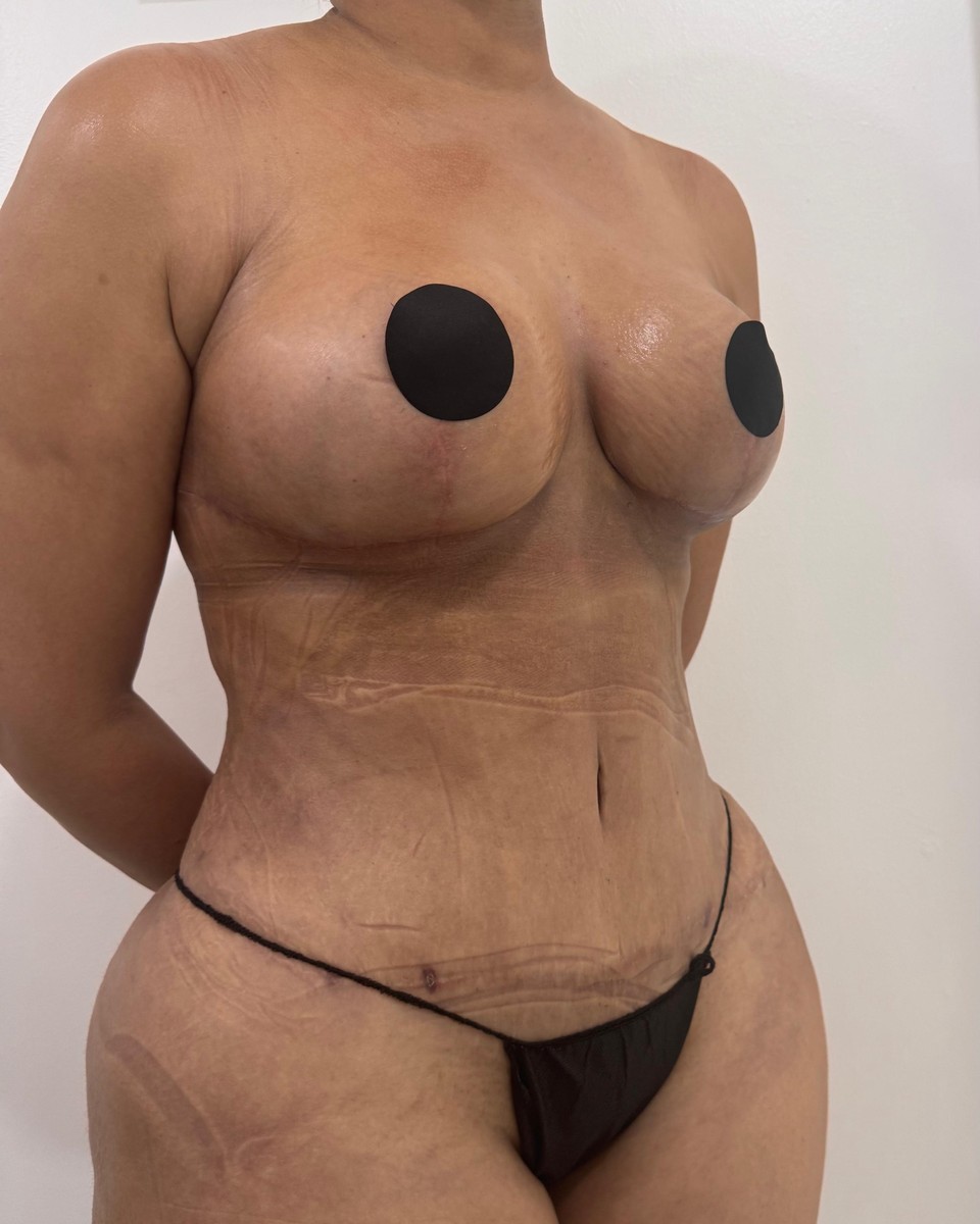 Lipoescultura - Después #5