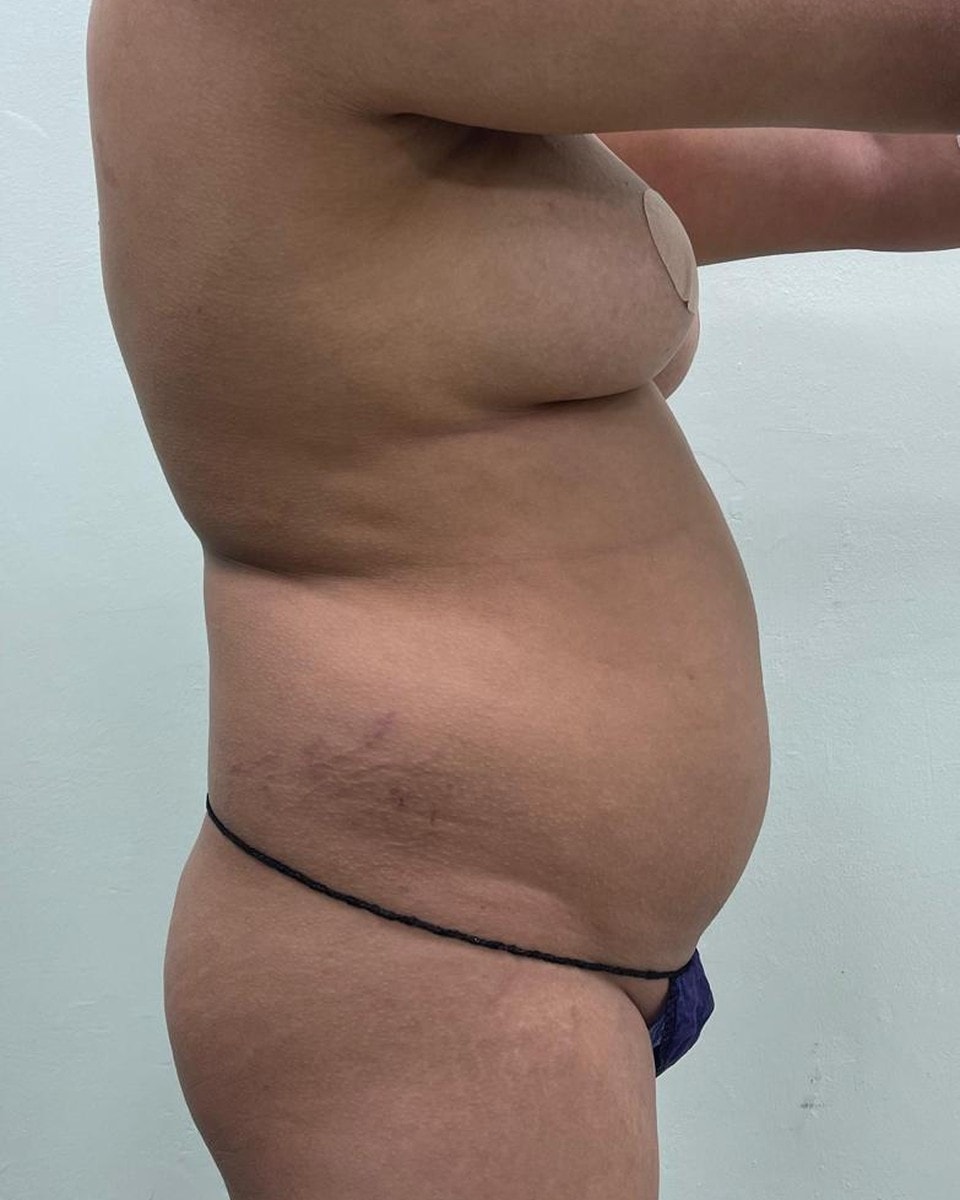 Lipoescultura - Antes