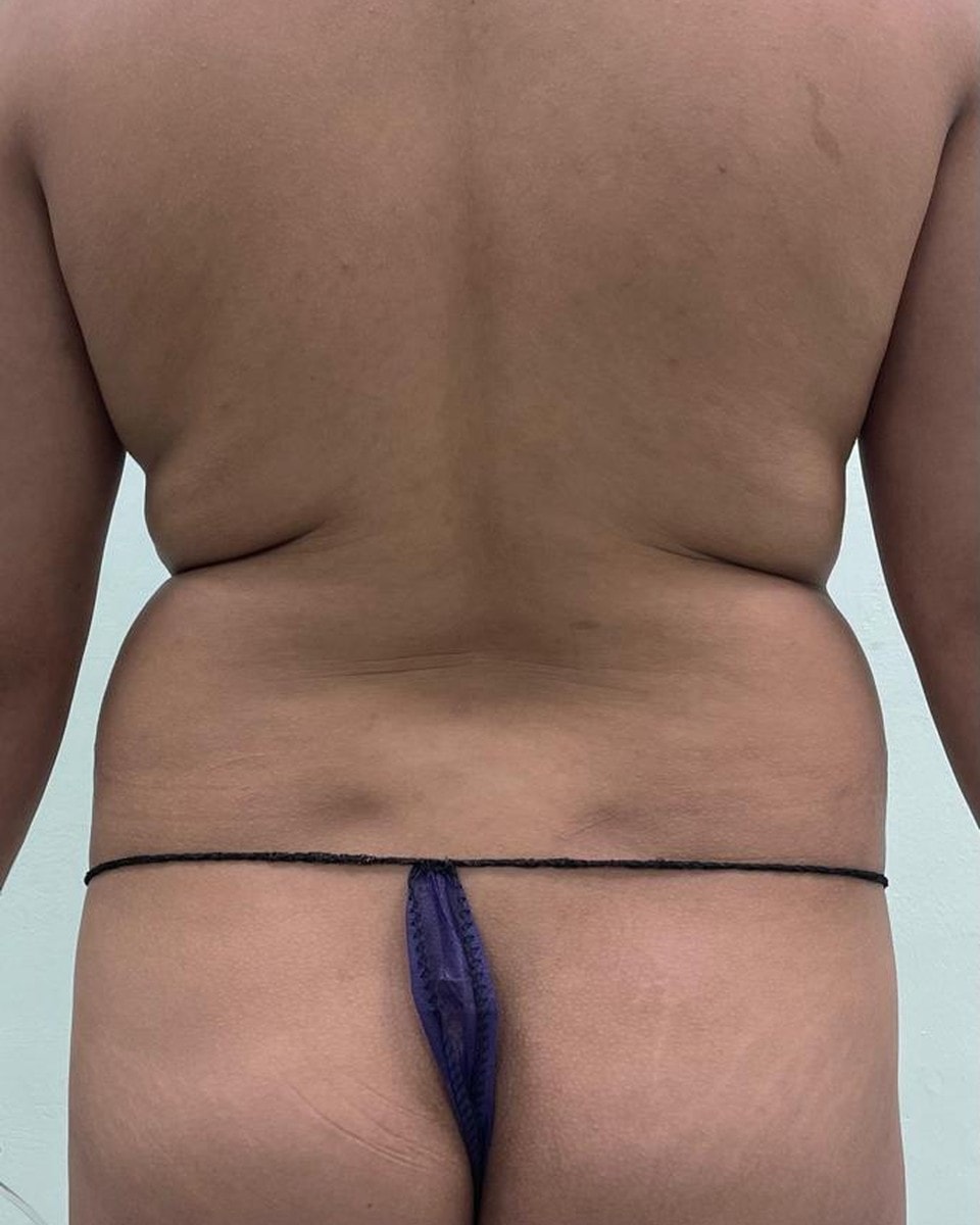 Lipoescultura - Antes