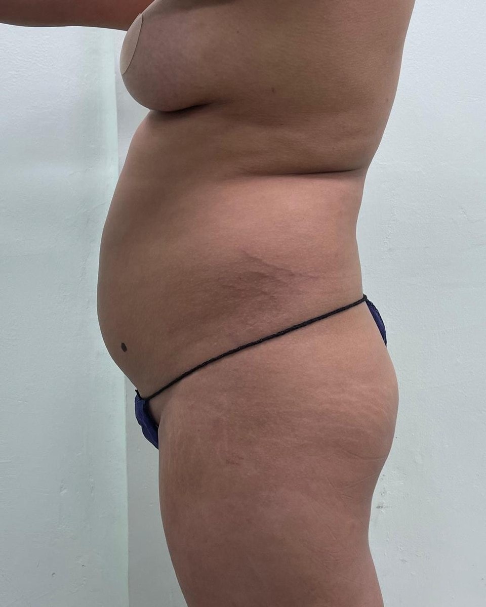 Lipoescultura - Antes