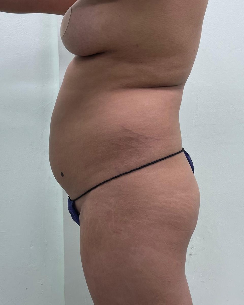 Lipoescultura - Antes #8