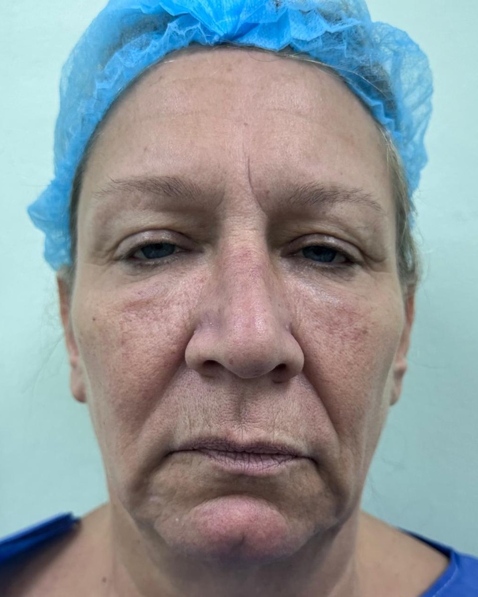 Lifting Facial