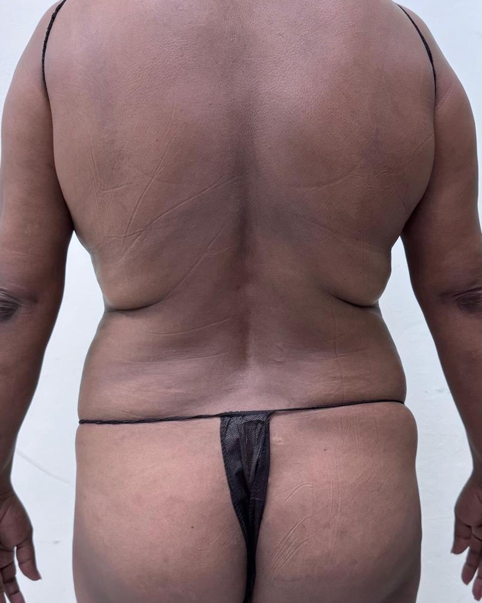 Lipoescultura de Espalda - Antes