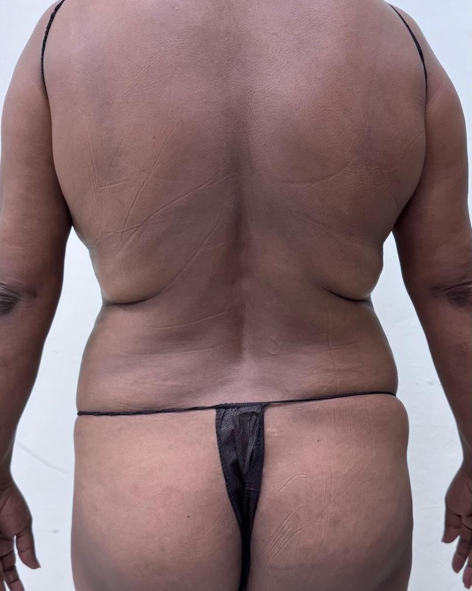 Lipoescultura de Espalda - Antes #1
