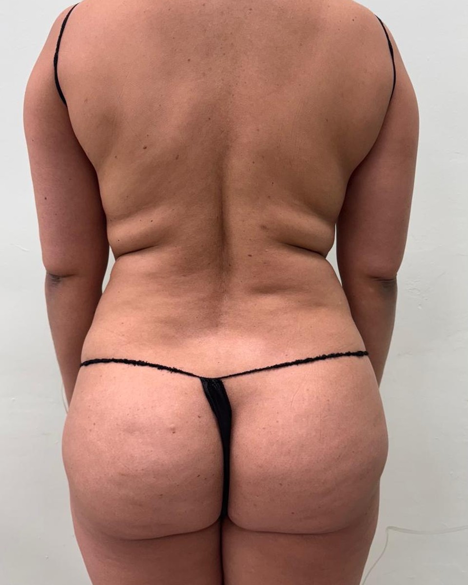 Lipoescultura de Espalda - Antes #2