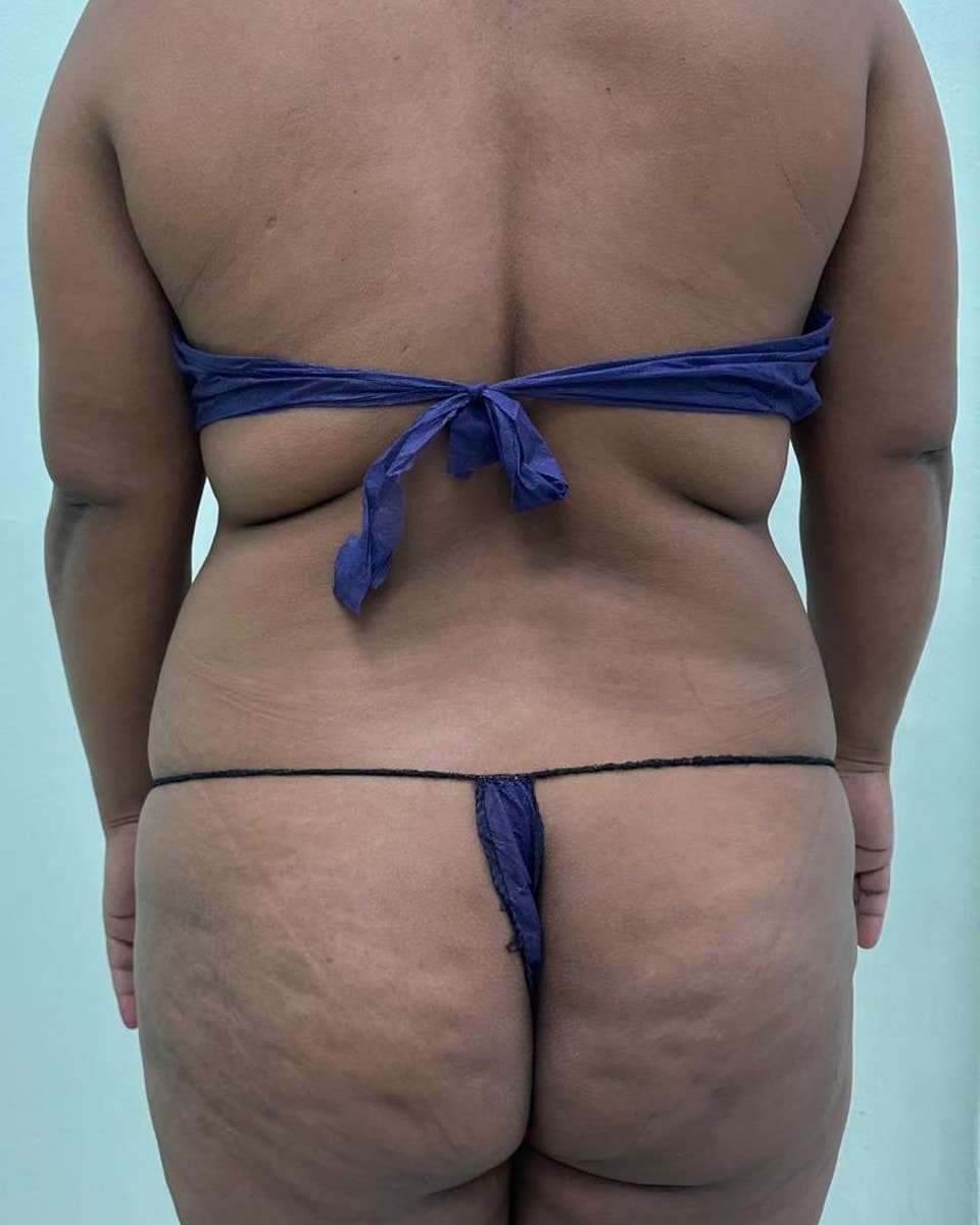 Lipoescultura de Espalda - Antes