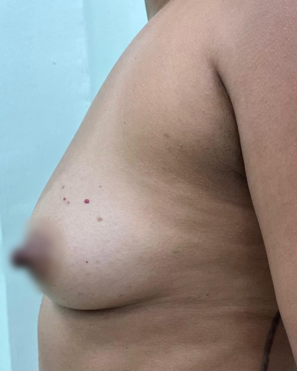 Mamoplastia de Aumento - Antes