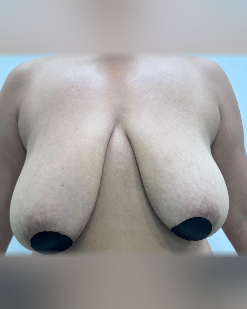 Mamoplastia de Reducción - Antes