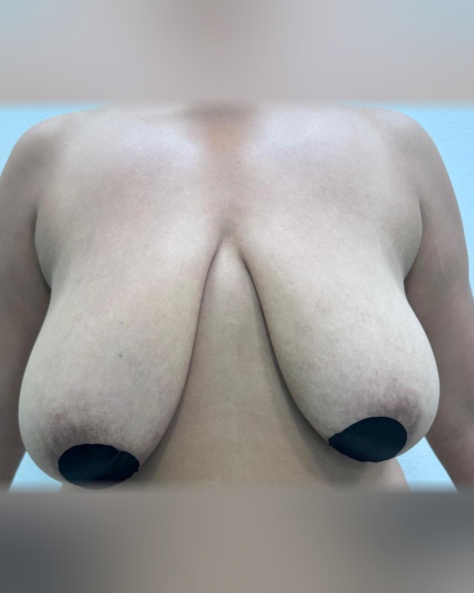 Mamoplastia de Reducción - Antes #1