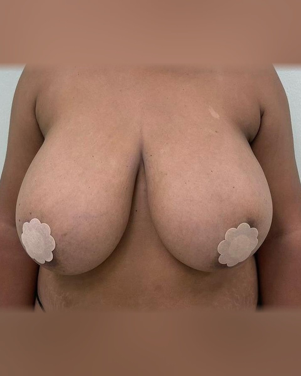 Mamoplastia de Reducción - Antes