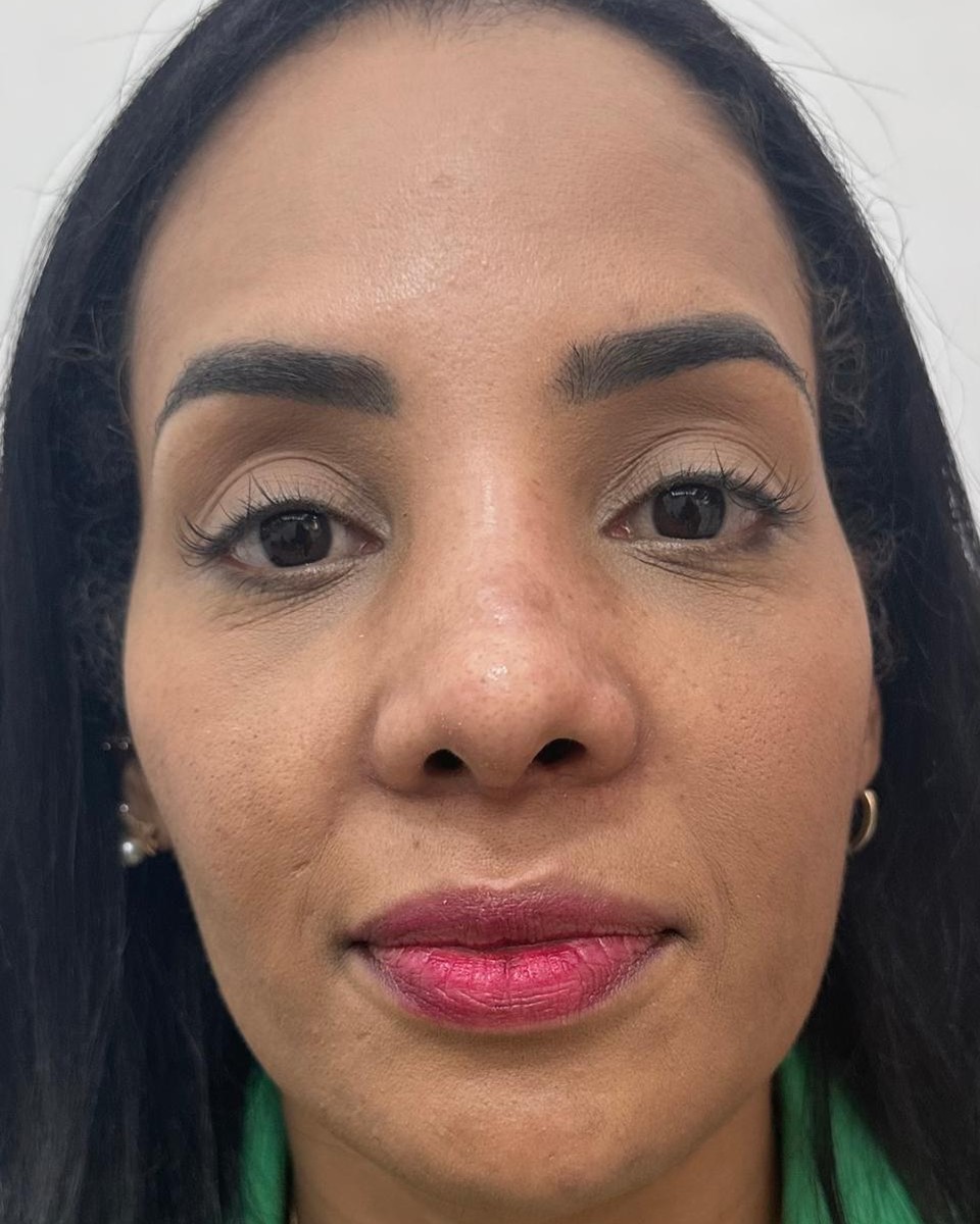 Rinoplastia - Antes #3